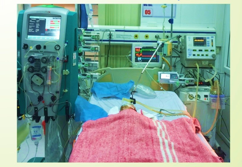 ỨNG DỤNG KỸ THUẬT LỌC MÁU LIÊN TỤC CỨU SỐNG NHIỀU BỆNH NHÂN NHI NẶNG
